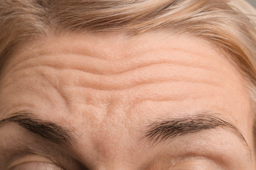 Women with forehead lines ready for San Diego Botox.